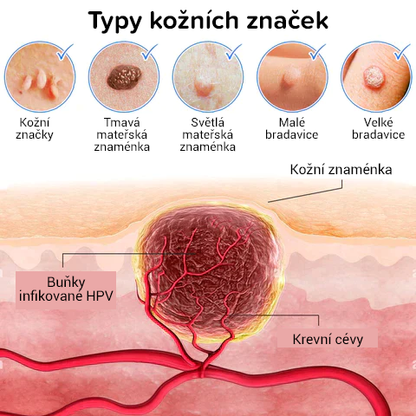 Krémy na kožní vady, mateřská znaménka a bradavice